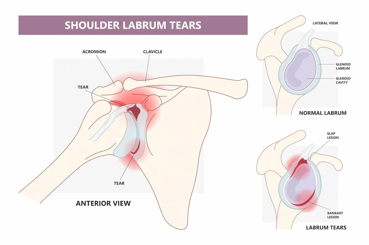 Medical illustration showing a Bankart labral tear of the shoulder joint, with comparison of normal labrum and labrum tear