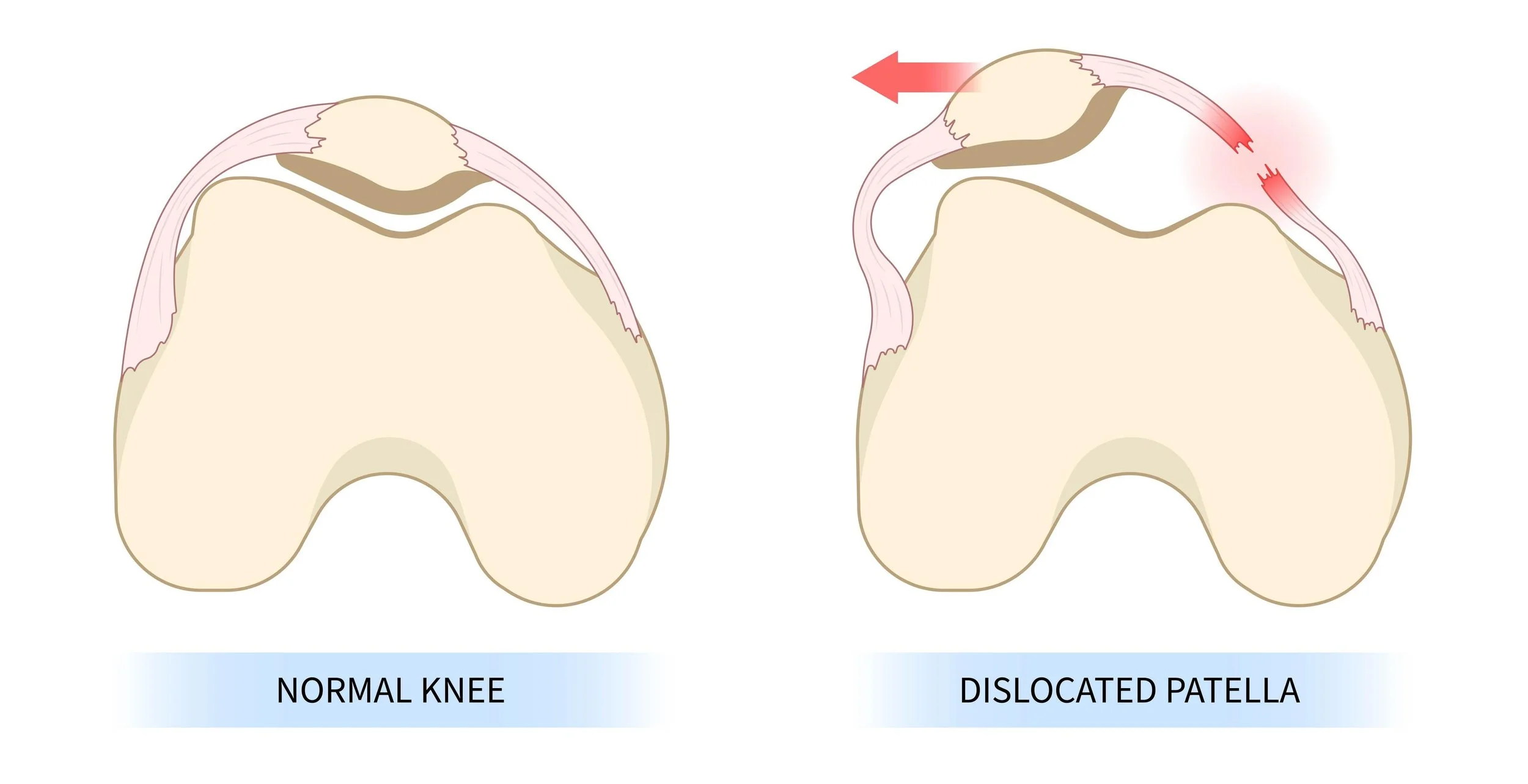 Diagram comparing a normal knee with the patella centred in the trochlear groove versus a dislocated patella displaced laterally