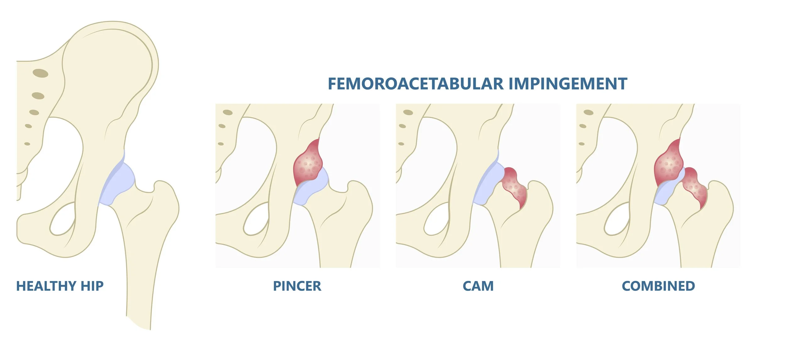 Diagram showing four types of hip joint: healthy hip, pincer impingement, cam impingement, and combined femoroacetabular impingement (FAI)