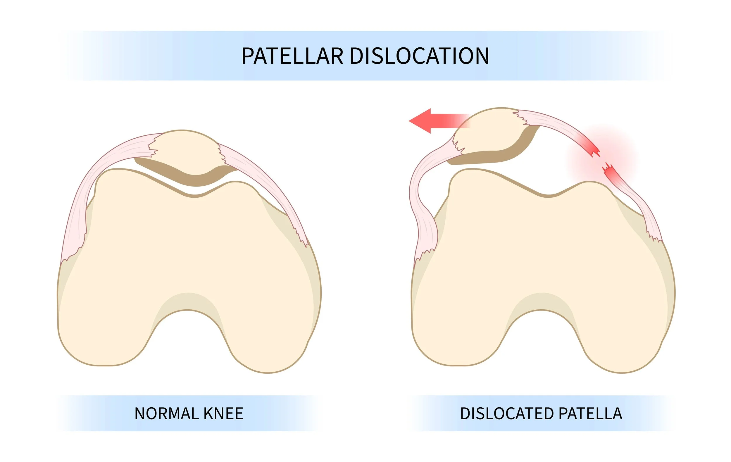 Diagram comparing a normal knee with the patella centred in the trochlear groove versus a dislocated patella displaced laterally
