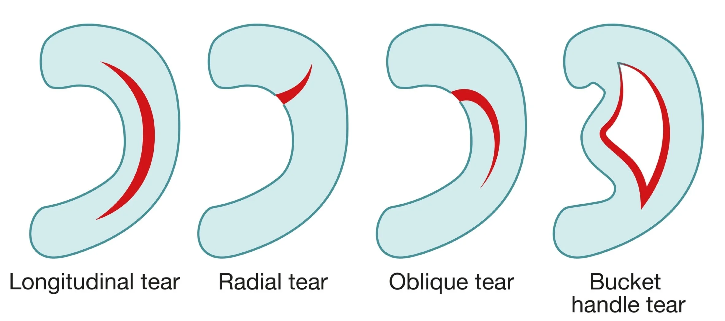 Four meniscal tear patterns seen from above: longitudinal, radial, oblique and bucket handle tears.