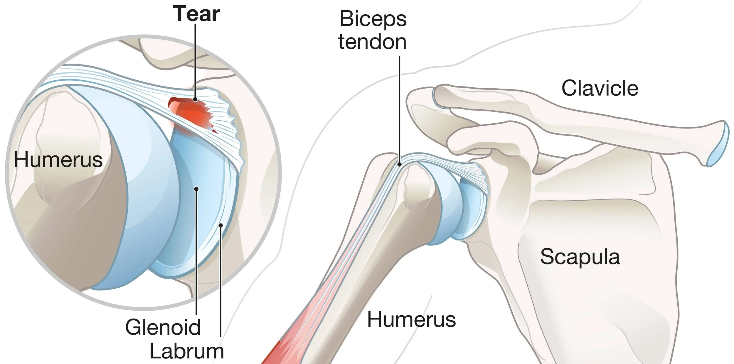 Diagram of the shoulder showing a SLAP tear of the glenoid labrum at the biceps tendon attachment