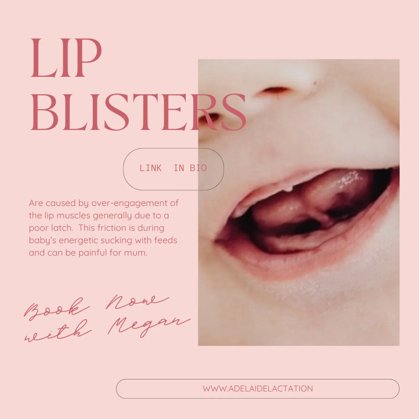 Lip blisters are a clue.
What happens when a body part works hard and experiences friction?  Callouses and blisters can occur.
Lip blisters don't automatically mean your baby has a lip tie (although oral ties can definitely cause them). They are AL