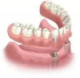 Implant Retained Dentures (click to view video)