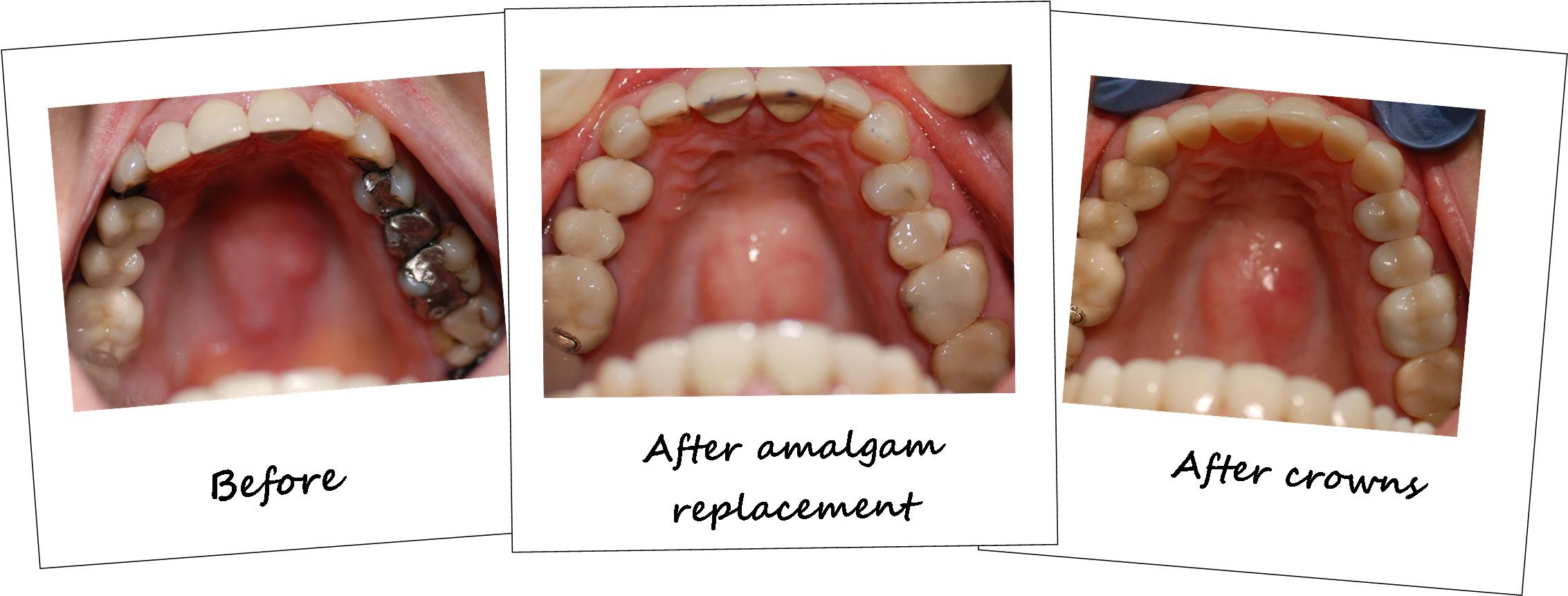 Tooth-colored Composite Fillings To Replace Silver