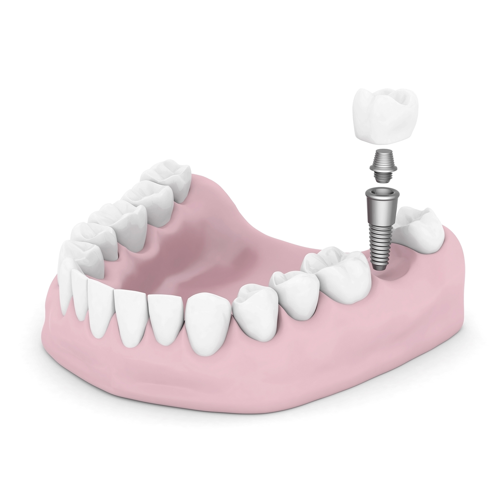How Do Implant Dentures Work?
