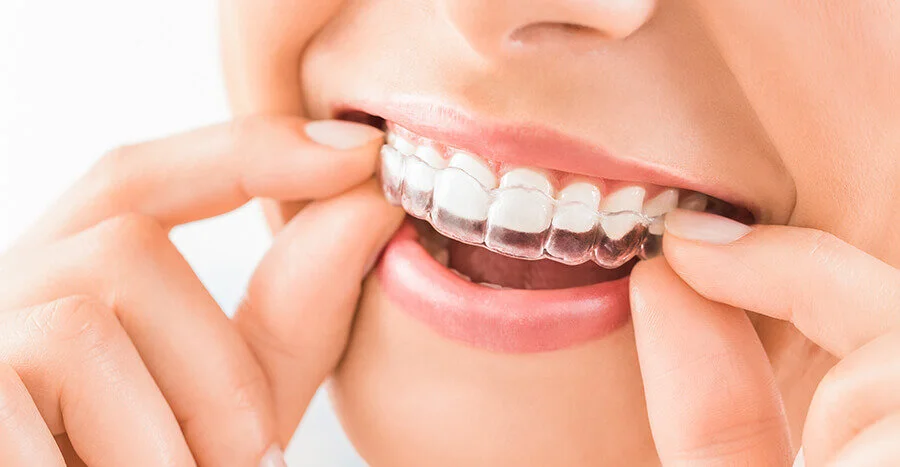 Accelerated Cosmetic Orthodontics