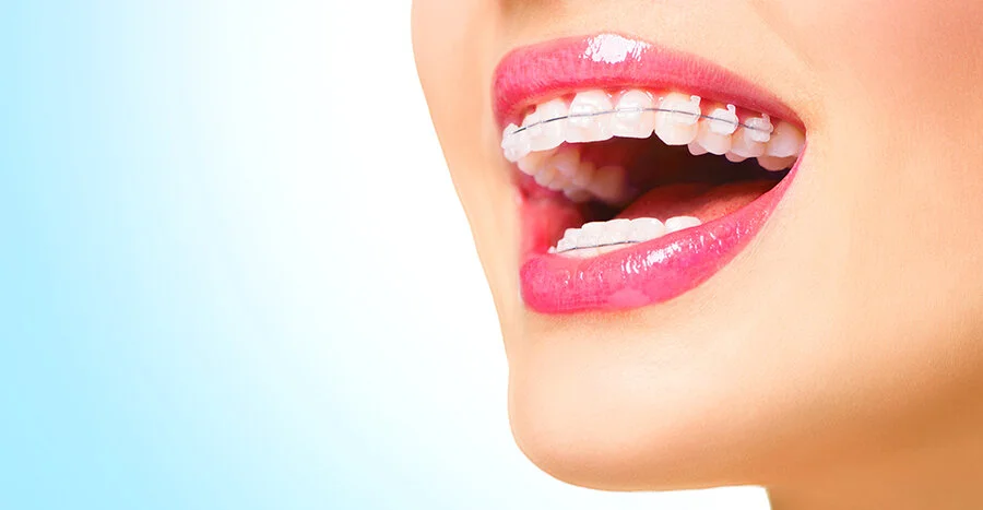 Do Clear Braces Take Longer?