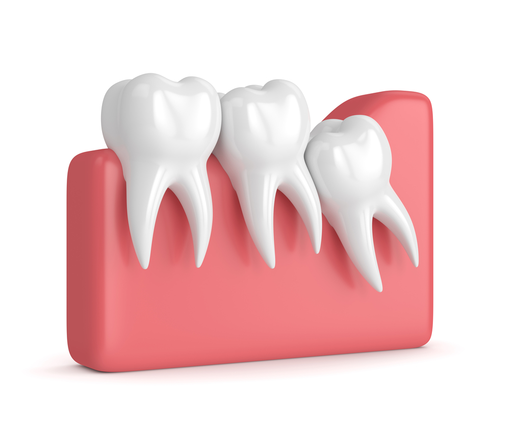 What Are the Signs You Need Wisdom Teeth Removal?