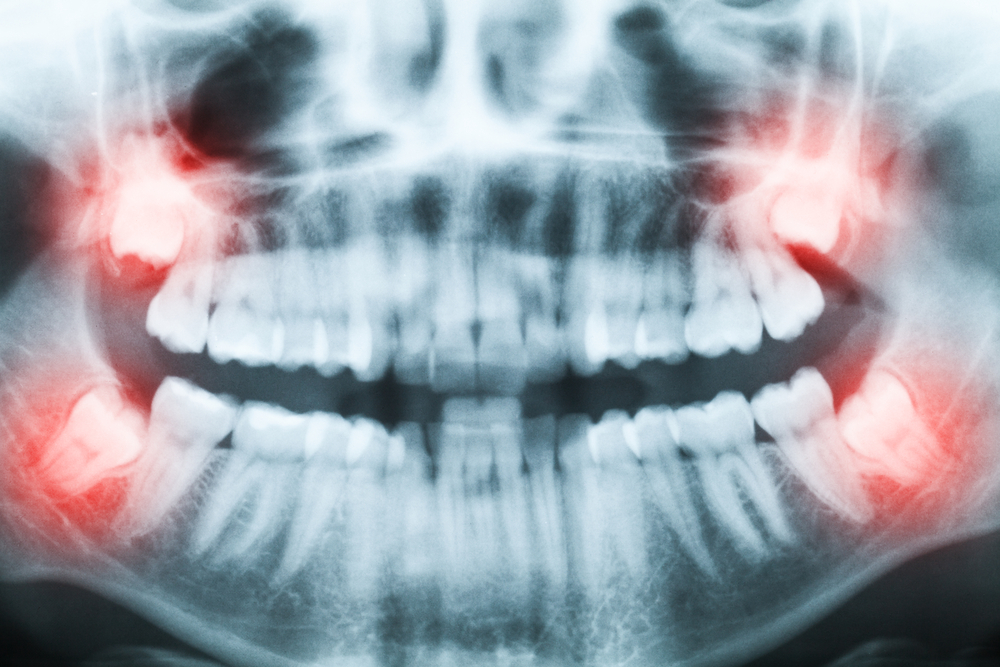 Wisdom Teeth Removal Recovery: How Long Does It Take?