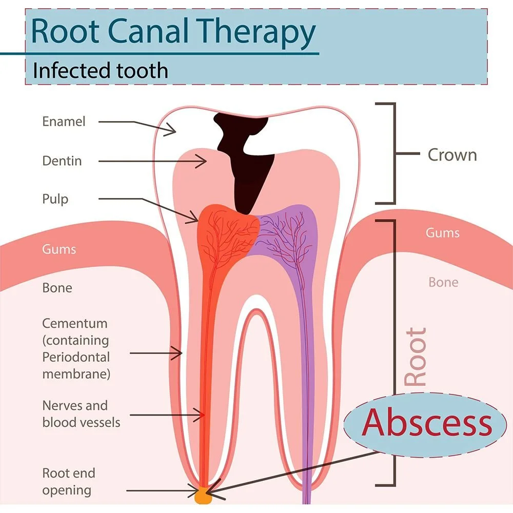 What is a root canal?