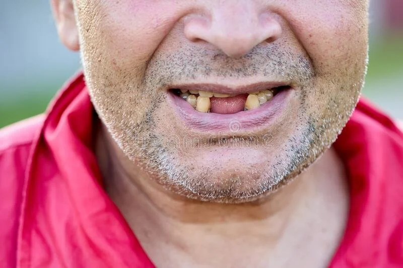 Does losing a tooth age you?