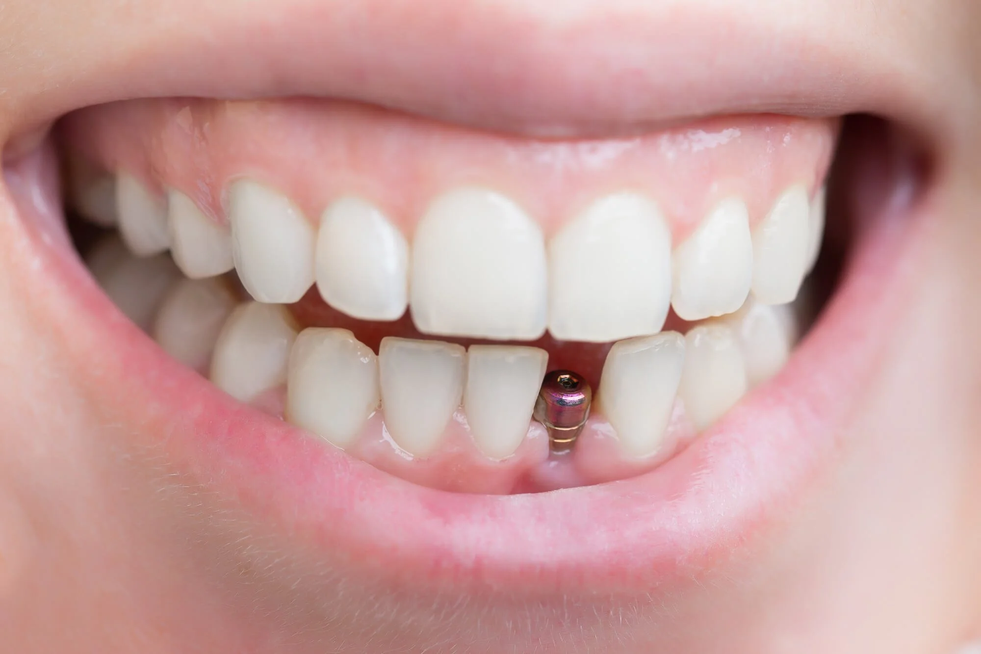 What is the best way to replace a tooth?