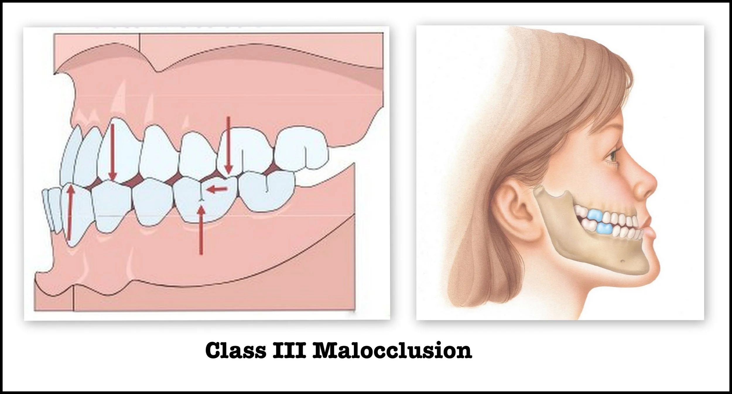 Correcting Class III malocclusion