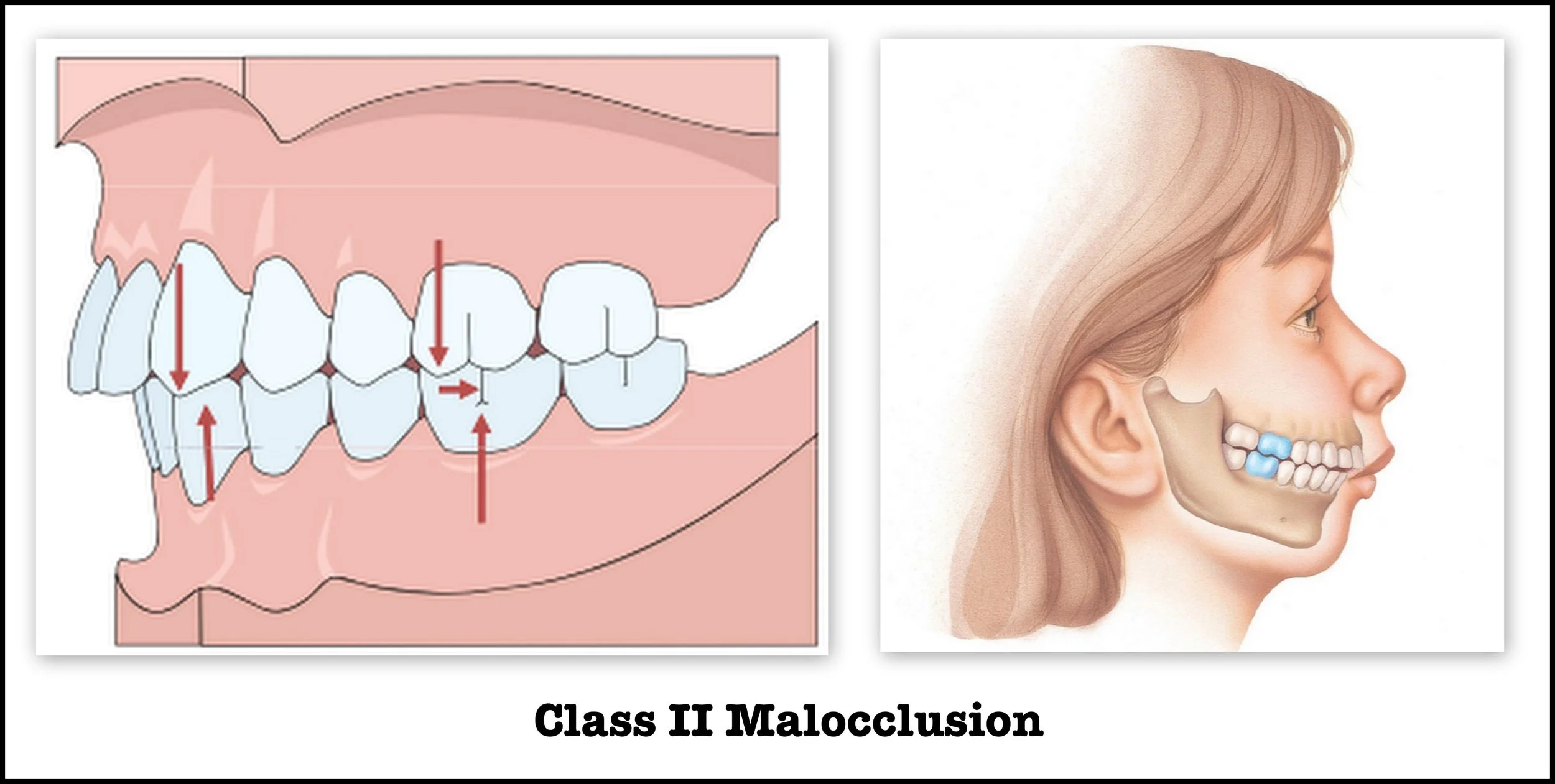 Correcting class II malocclusion