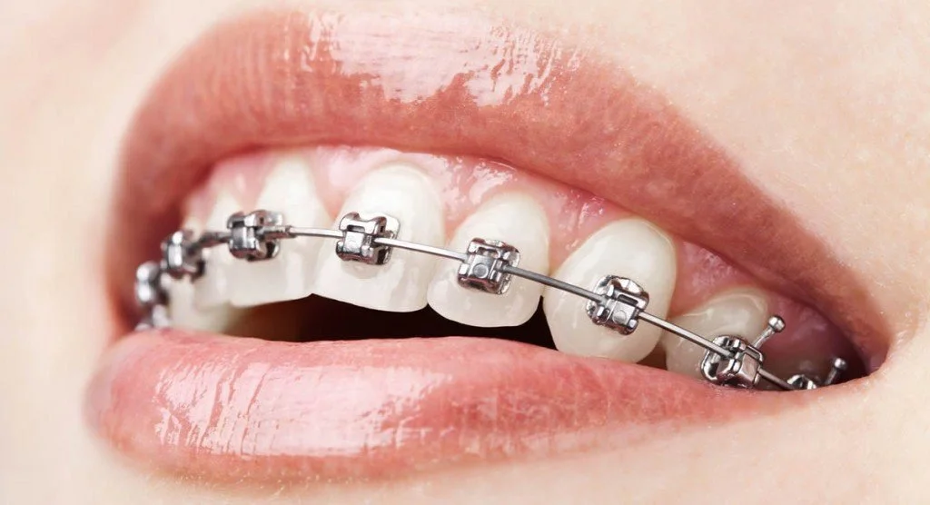 Debunking 5 popular myths about braces