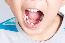 Debunking 5 popular myths about children with a high number of cavities
