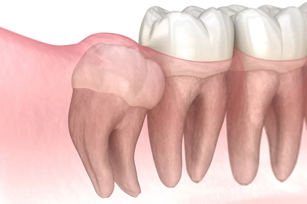 Debunking 5 popular myths about wisdom teeth