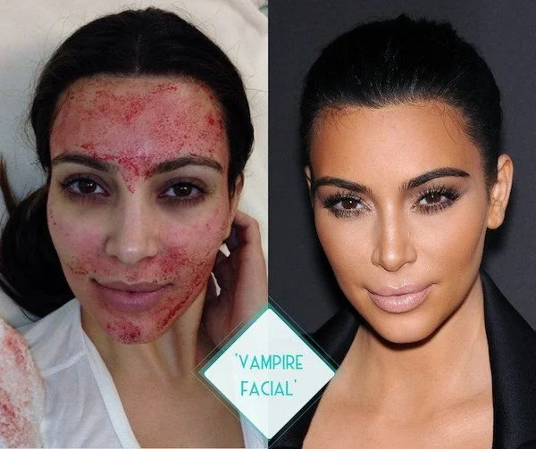 Unmasking the Vampire Facial