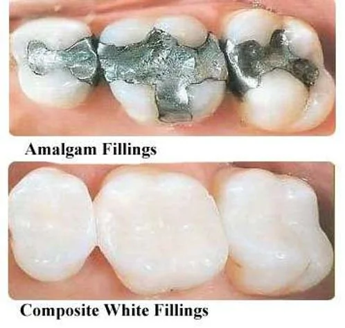 Say Goodbye to Silver Fillings: A Safer Choice for Your Smile