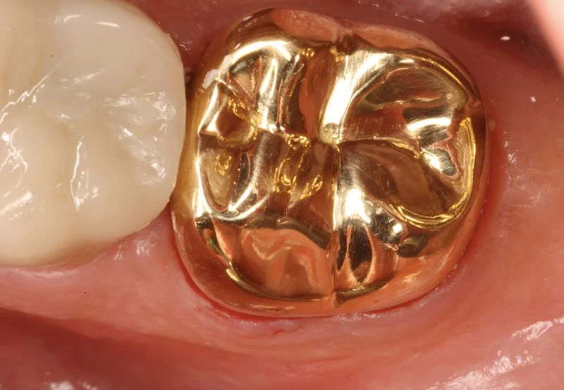 Sparkle Your Smile with Gold Crowns at Dr. Cajee's Dental Office in Manteca, California!