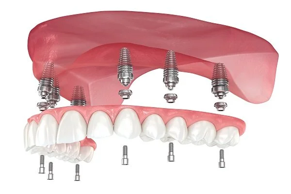 Get Your Smile Back: The Magic of Denture Implants in Manteca, California