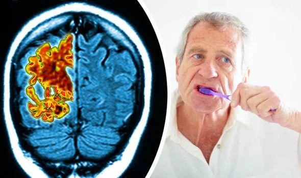 Connection Between Periodontal Disease and Alzheimer's