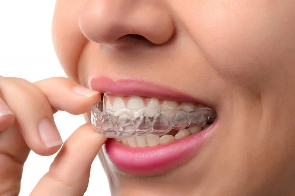 What are aligners good for?