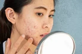 What are 5 Yummy Foods to Kick Acne to the Curb?