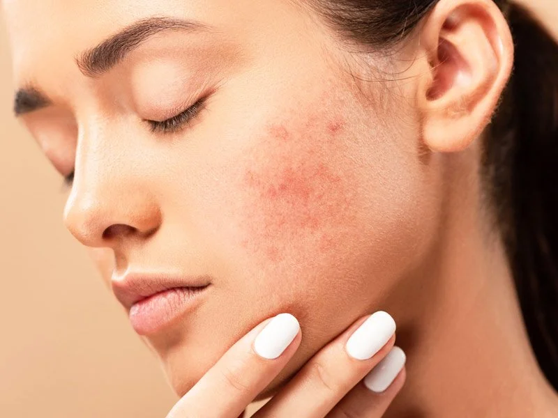 What are 5 Fast Food Pitfalls That May Worsen Acne in Manteca?