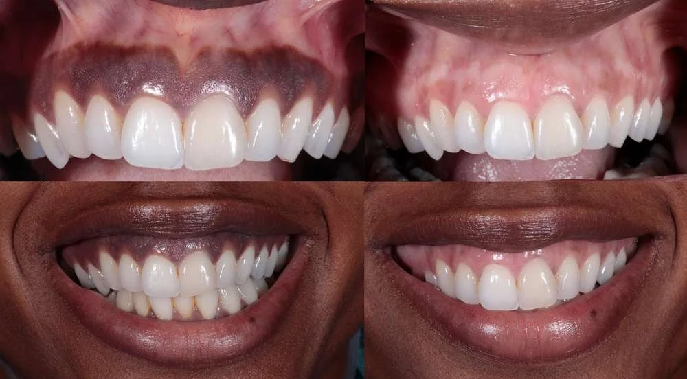 What are 5 Simple Ways to Lighten Dark Gums and Boost my Confidence?