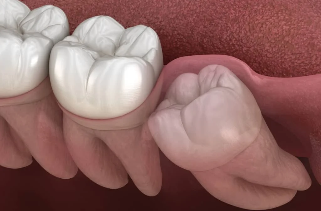 Why Do Dentists Prefer to Remove Wisdom Teeth Early and All at Once? 5 Key Reasons