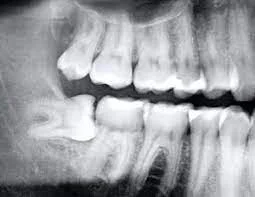Can Impacted Wisdom Teeth Correct Themselves Over Time?