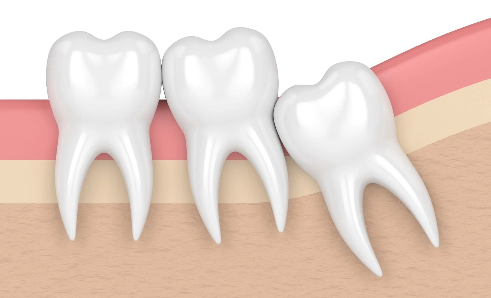 Why Is It So Important to Save Your Molars?