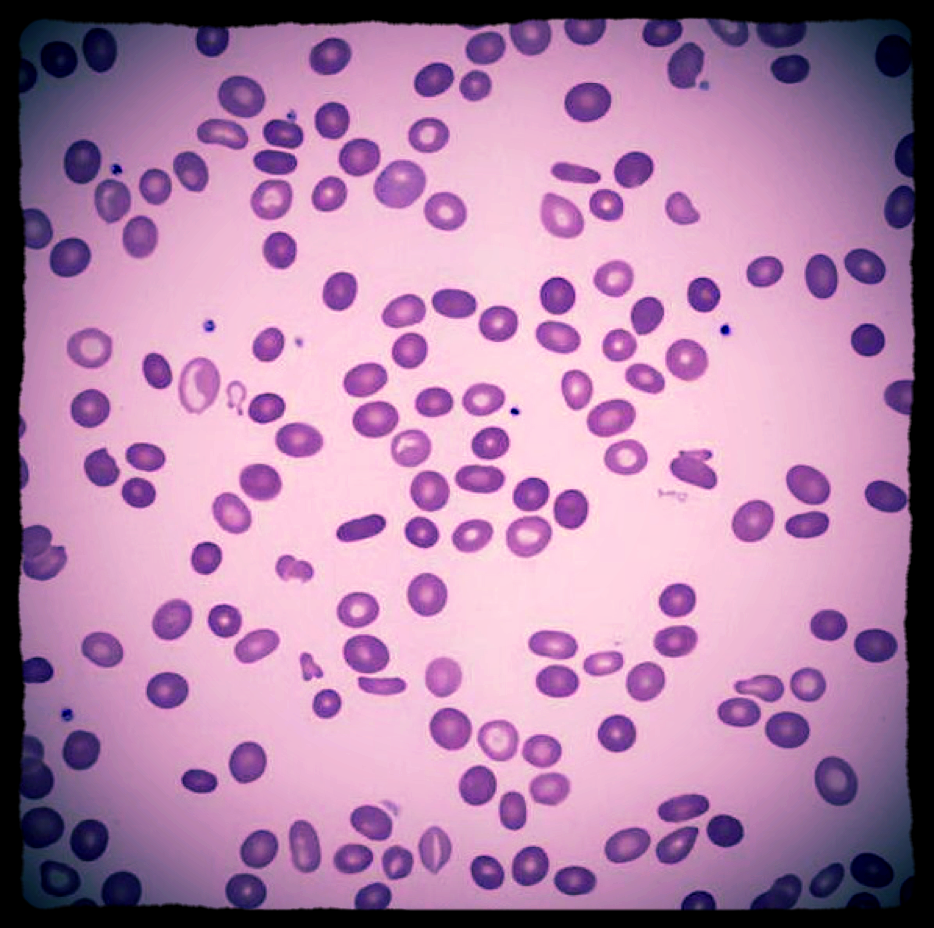 Erythryleukemia w Underlying MDS .png