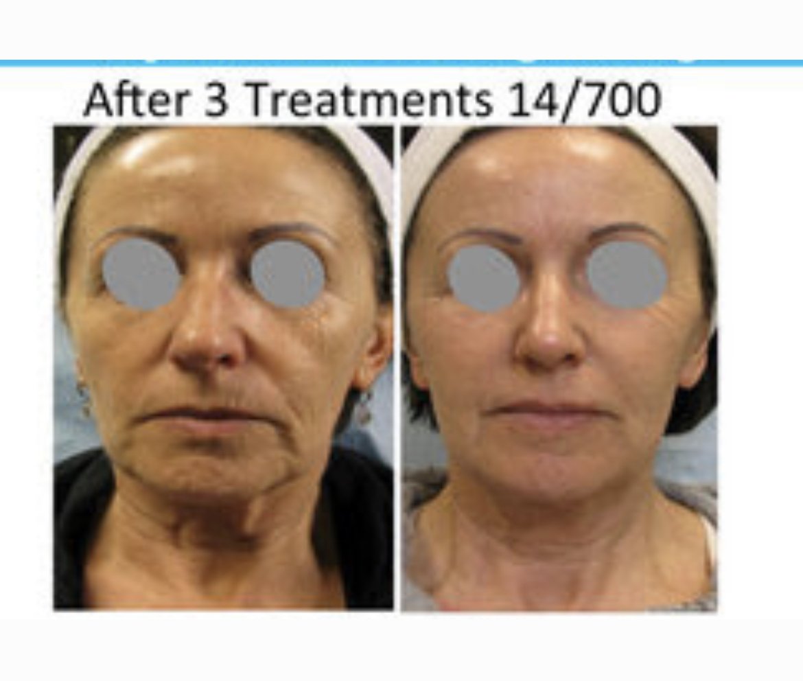 Before and After Tixel treatments