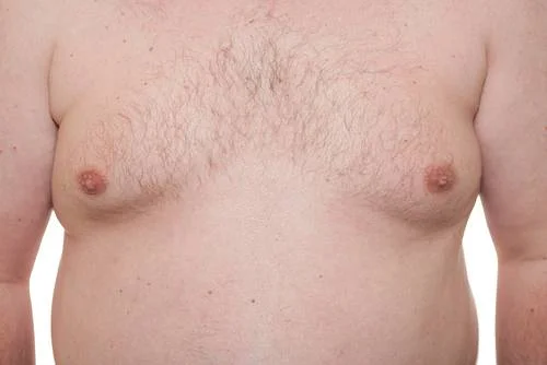 A Simple Solution to Man Boobs, Moobs and Gynecomastia!