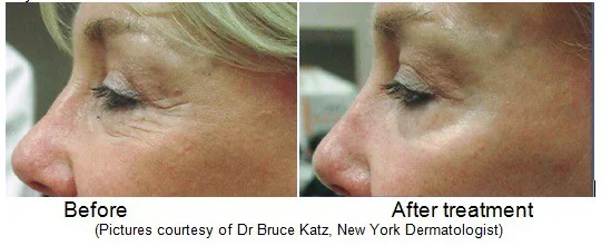 The Madonna Eye Lift, An Alternative to Blepharoplasty