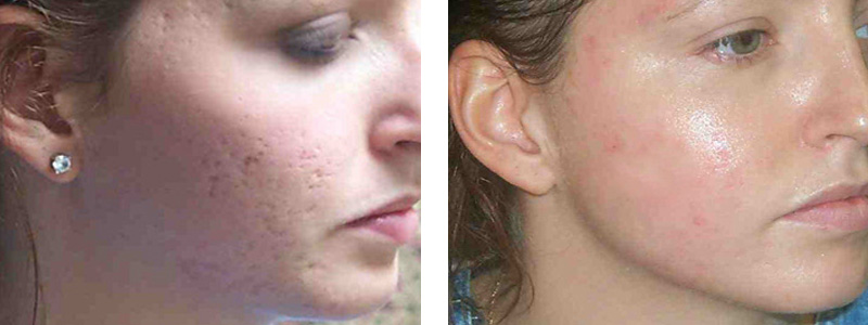 molecule Snowstorm Or either Rid Acne Scars With the SmartXide DOT CO2 — SkinSpaMED