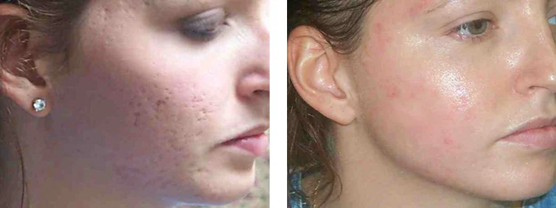 Rid Acne Scars With the SmartXide DOT CO2