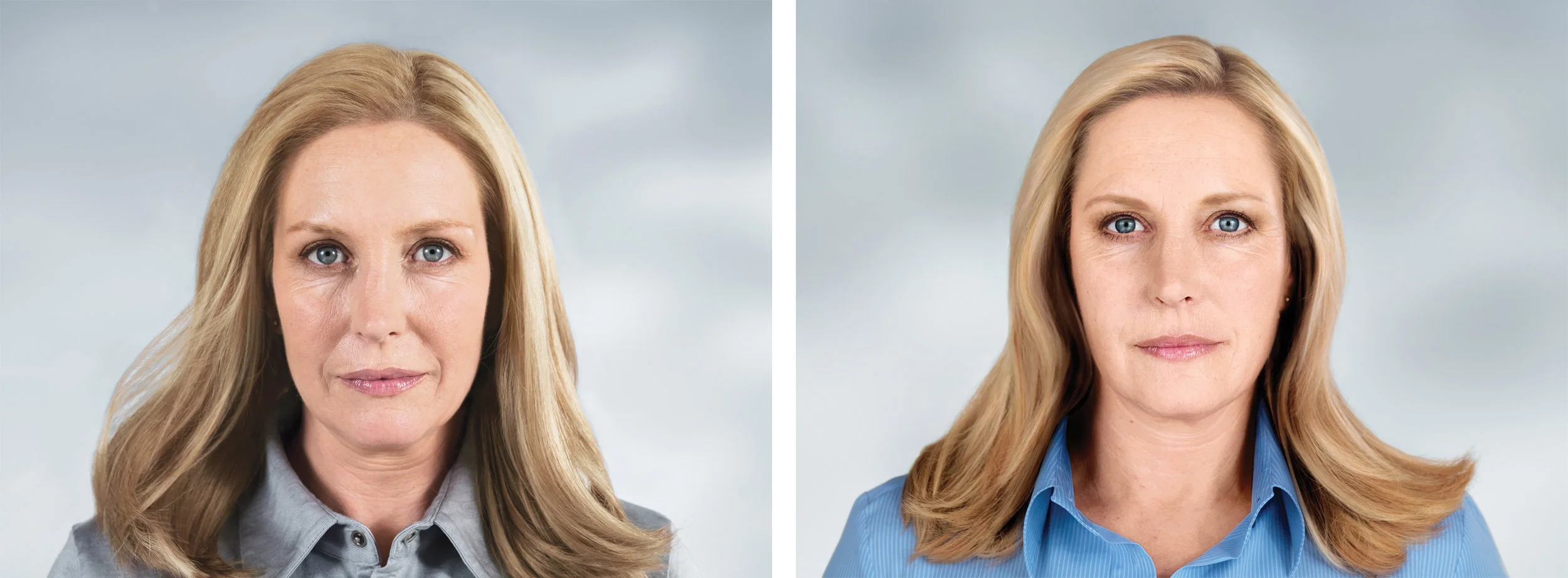 Before-and-after photo of a 49-year-old treated with Sculptra. Treatment included: 5 visits over 25 months.
