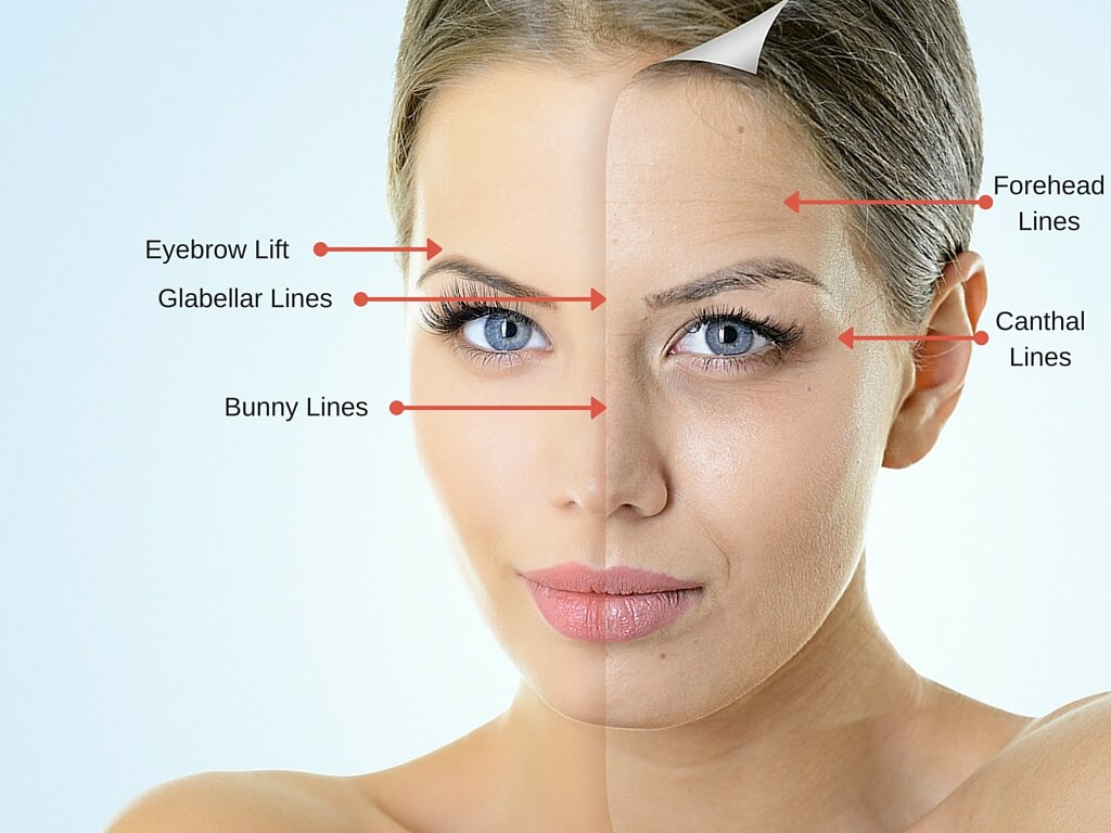 Charging by the Area: Dysport and Botox Pricing