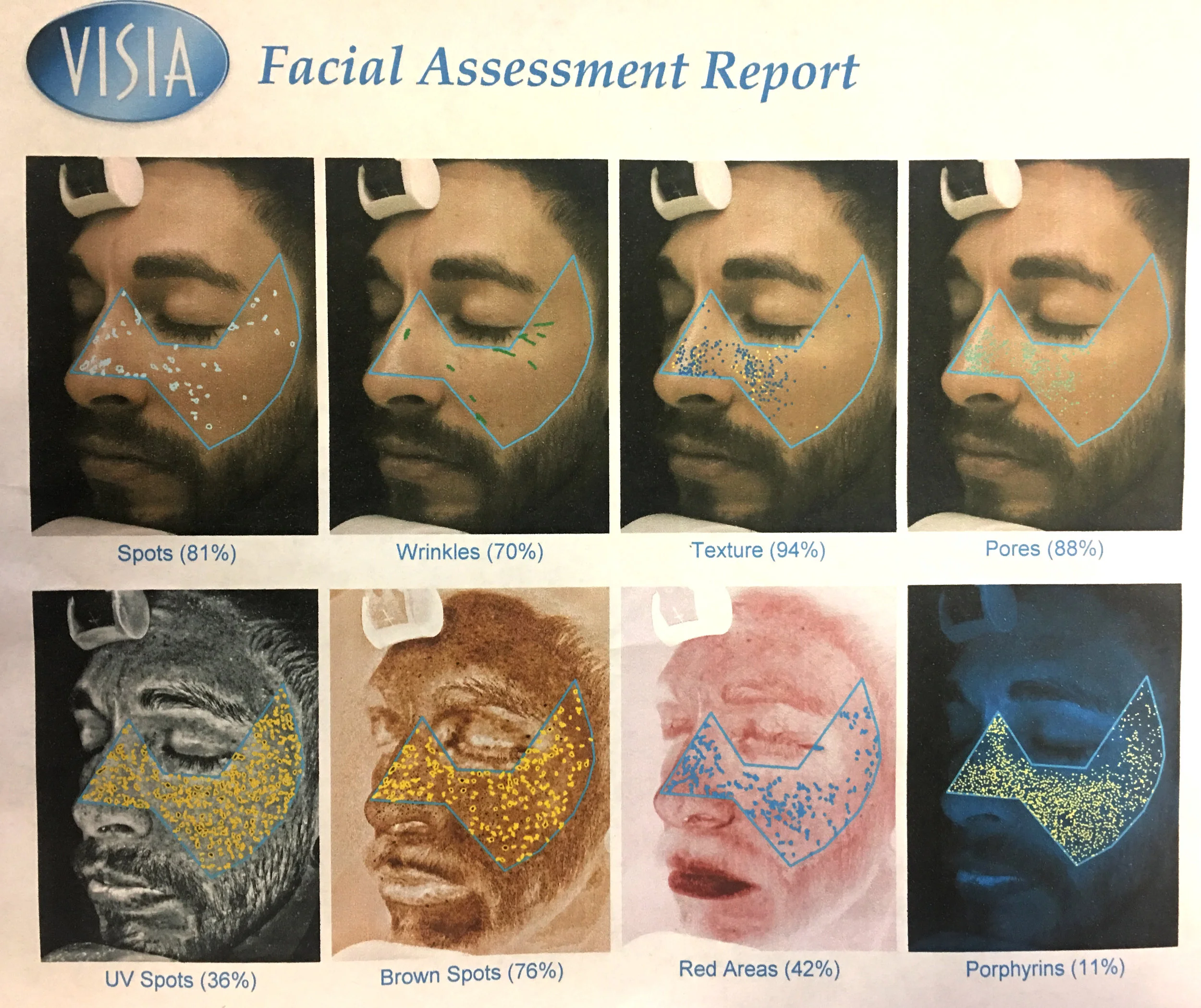 Visia Skin Analysis