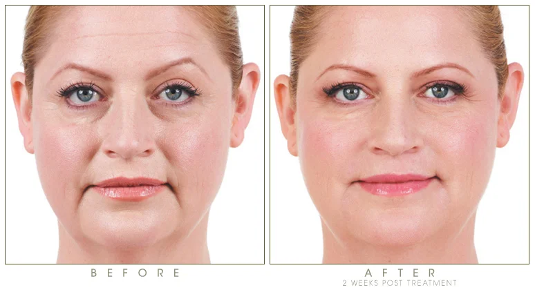 The Game Changing Filler: Voluma
