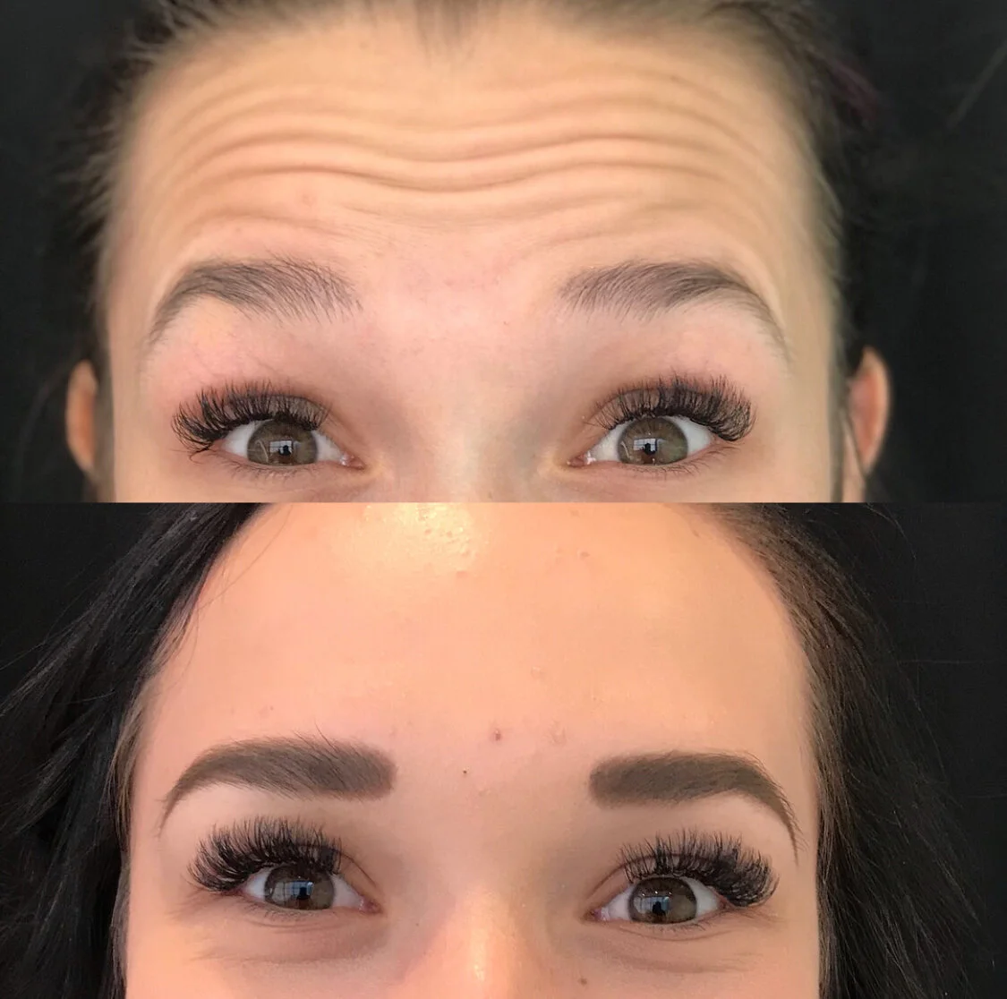 What is Neurotoxin and what are the brand differences?