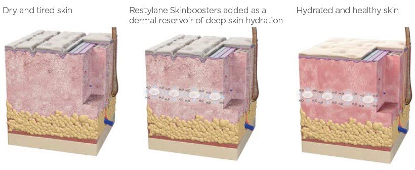 SKINBOOSTERS – ALL YOU NEED TO KNOW