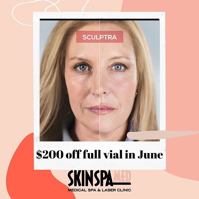 Sculptra is an amazing product. We are discounting it by $200 a vial in June! 
#sculptra, #skindpamed