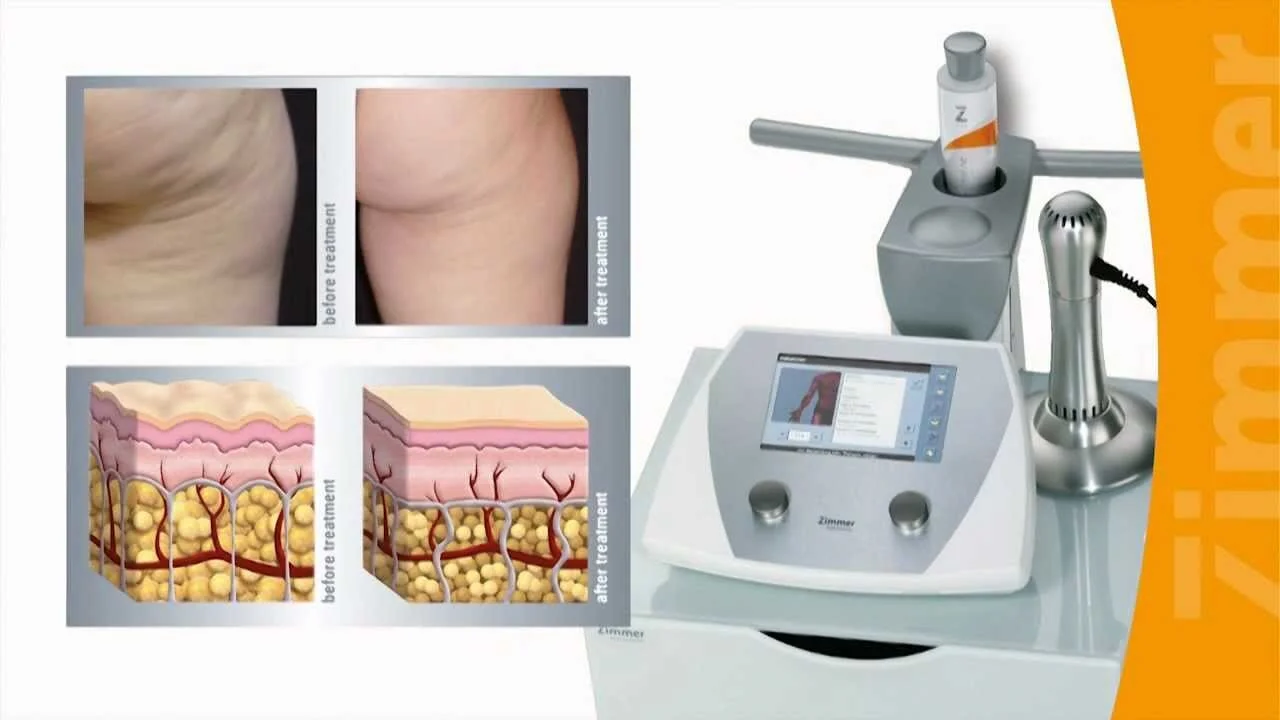 Center for Classic Beauty’s Dr. Anna Petropoulos Receives Z Wave Q Cellulite Treatment and Discusses this “Comfortable” Treatment