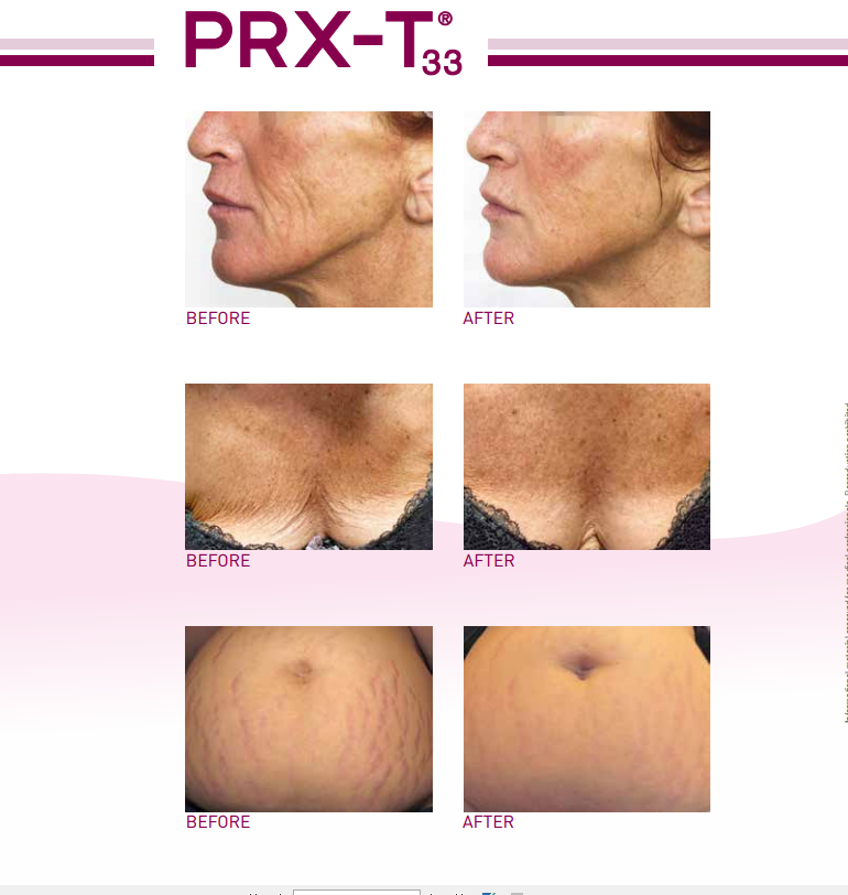 “Effortless transformation” PRX-T33 revolution in aesthetic industry in the US