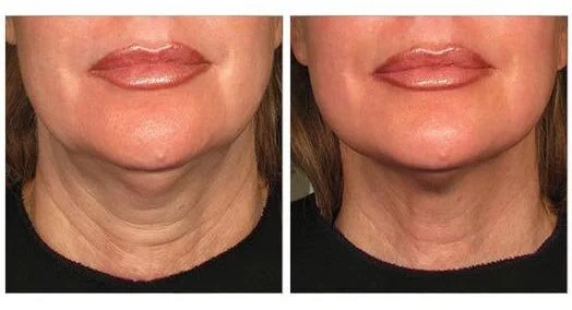 The Non-Invasive Facelift